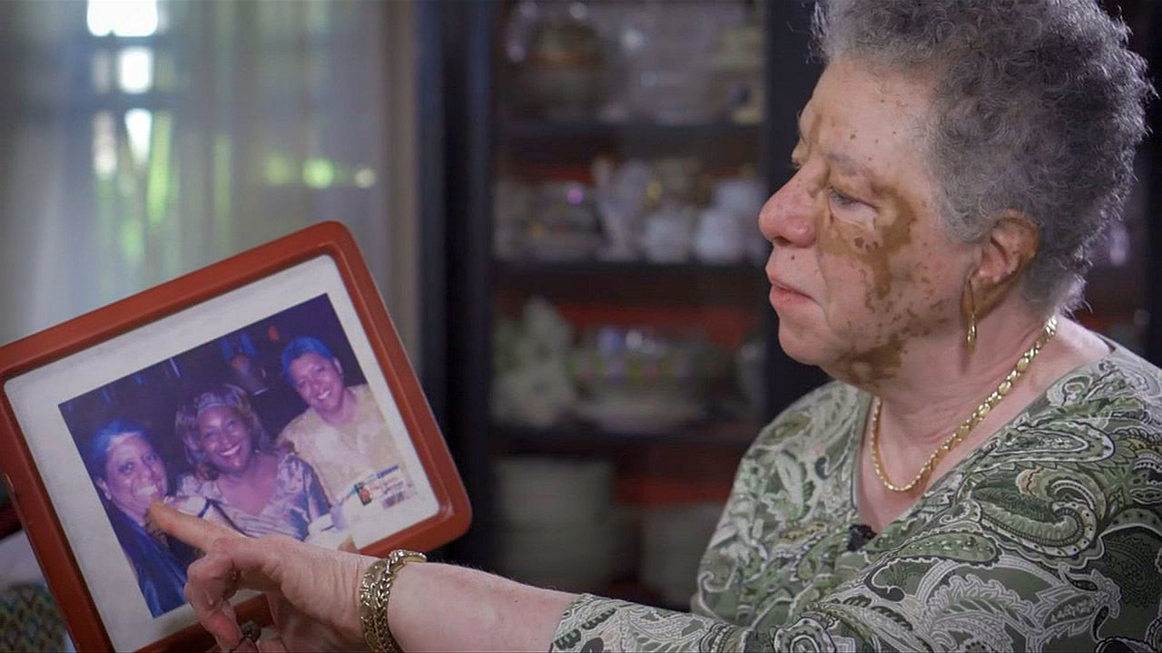 10-10-19 Barbara Hamilton - vitiligo.jpg